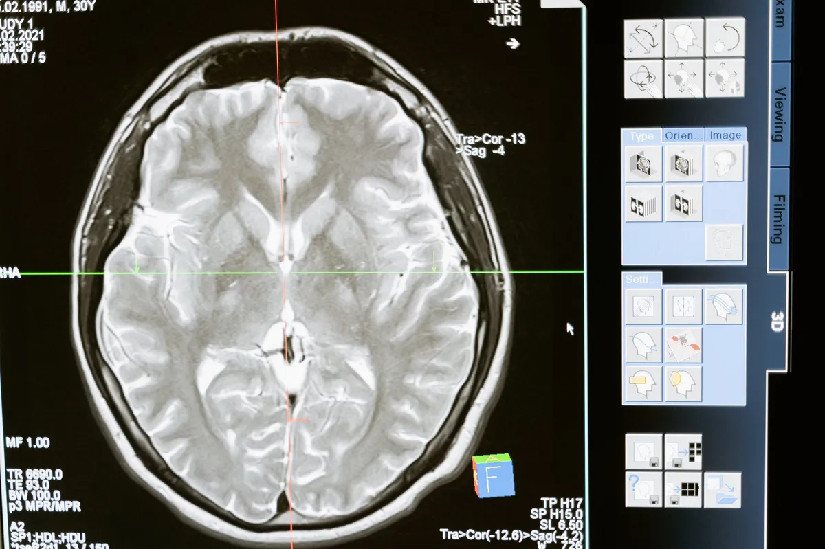 brain scan illustration