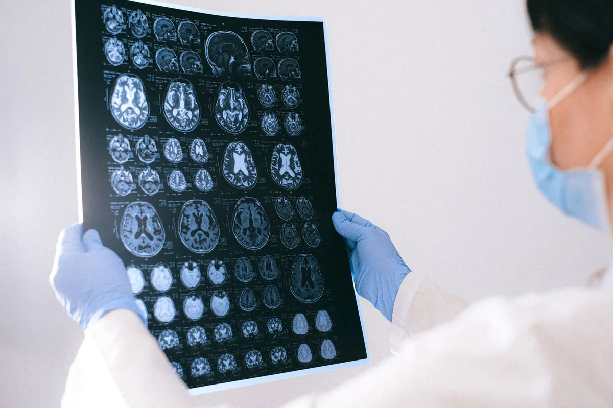 New Insights into Alzheimer’s: Immune Cells Outside the Brain May Drive Damage